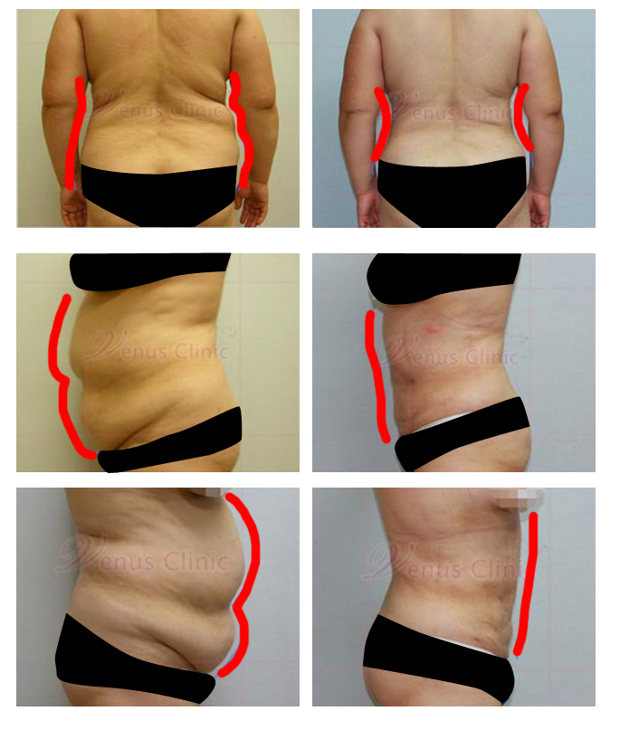 복부지방흡입2.jpg