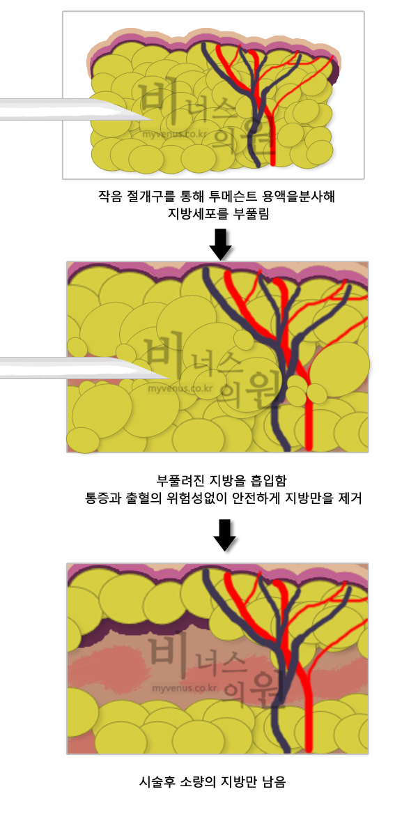 복부지방흡입1.jpg