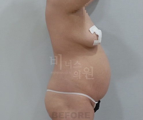 전측복부_옆구리_3_before.jpg