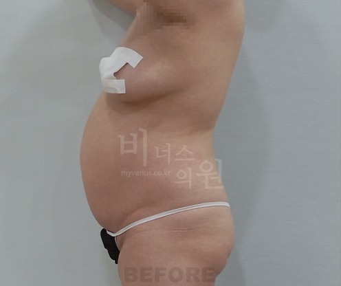 전측복부_옆구리_2_before.jpg