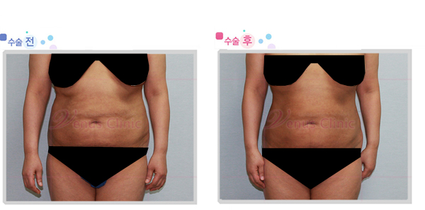 지방흡입재수술1.jpg