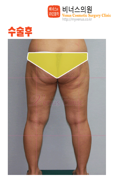 허벅지지방흡입2.gif