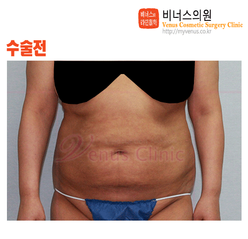 복부지방흡입재수술.gif