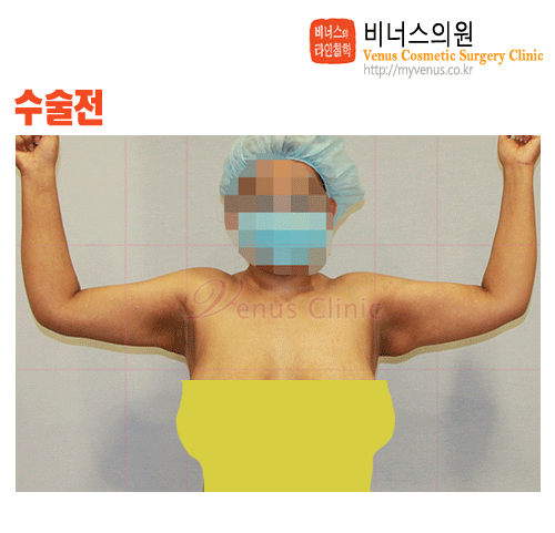 팔지방흡입.gif