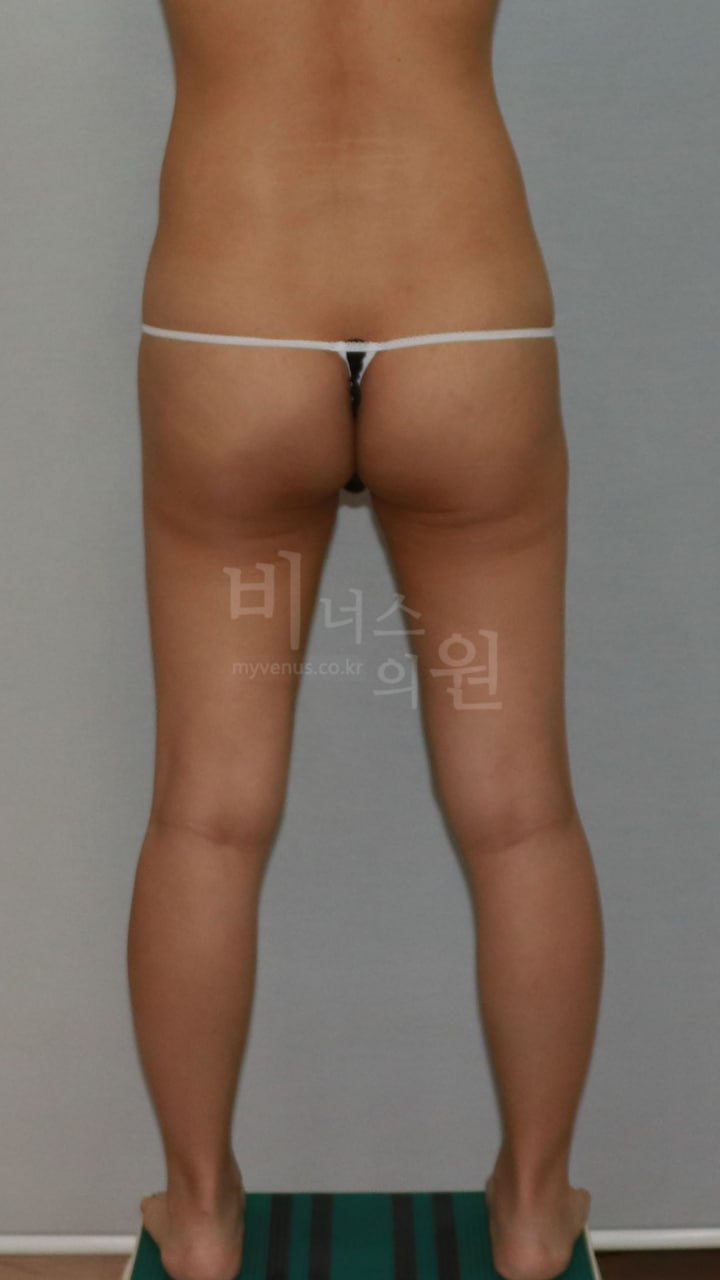 엉덩이 볼륨업 지방흡입 수술 전 후면 클로즈업 비너스의원
