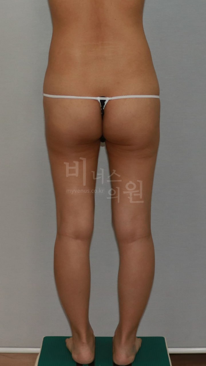 엉덩이 볼륨업 지방흡입 수술 전 후면 비너스의원
