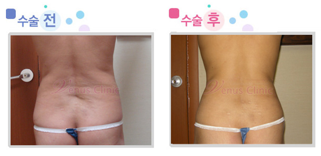 지방흡입8.jpg