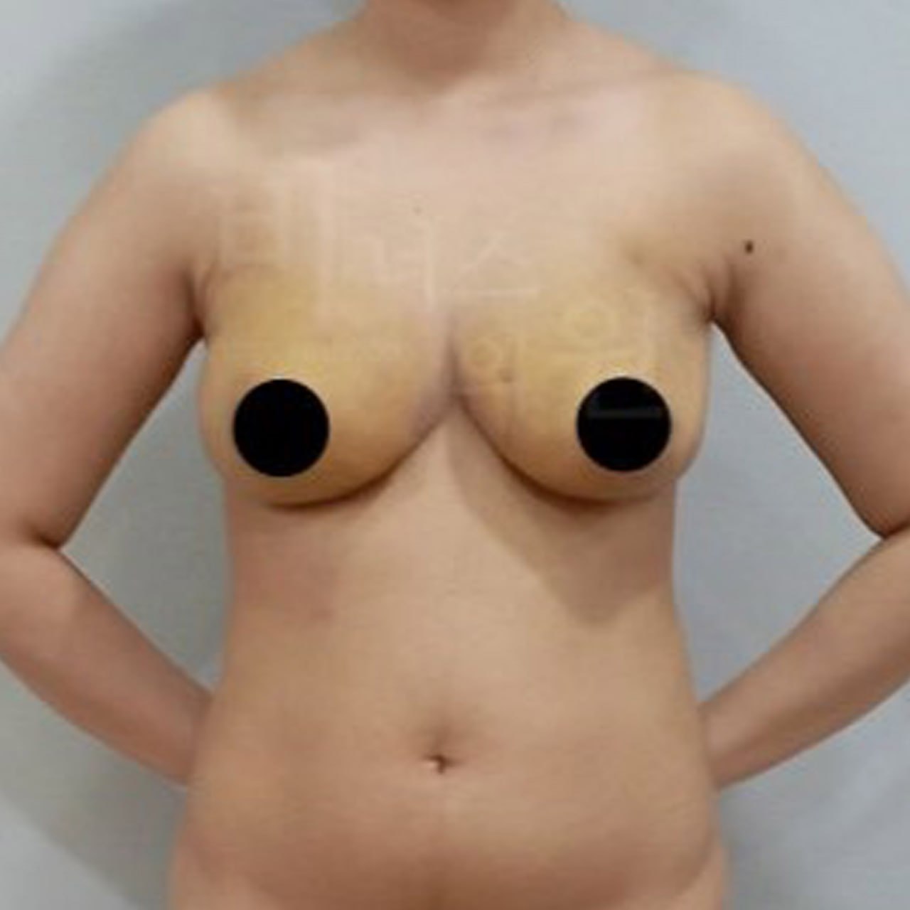 가슴축소 지방흡입 수술 후 정면 비너스의원