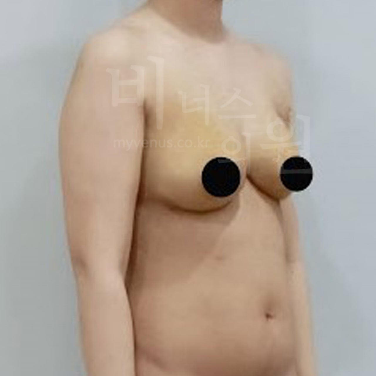 가슴축소 지방흡입 수술 후 왼측 45도 비너스의원