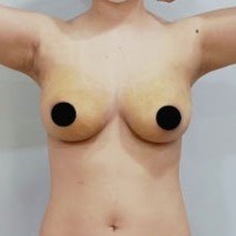가슴축소 지방흡입 수술 후 정면 2 비너스의원