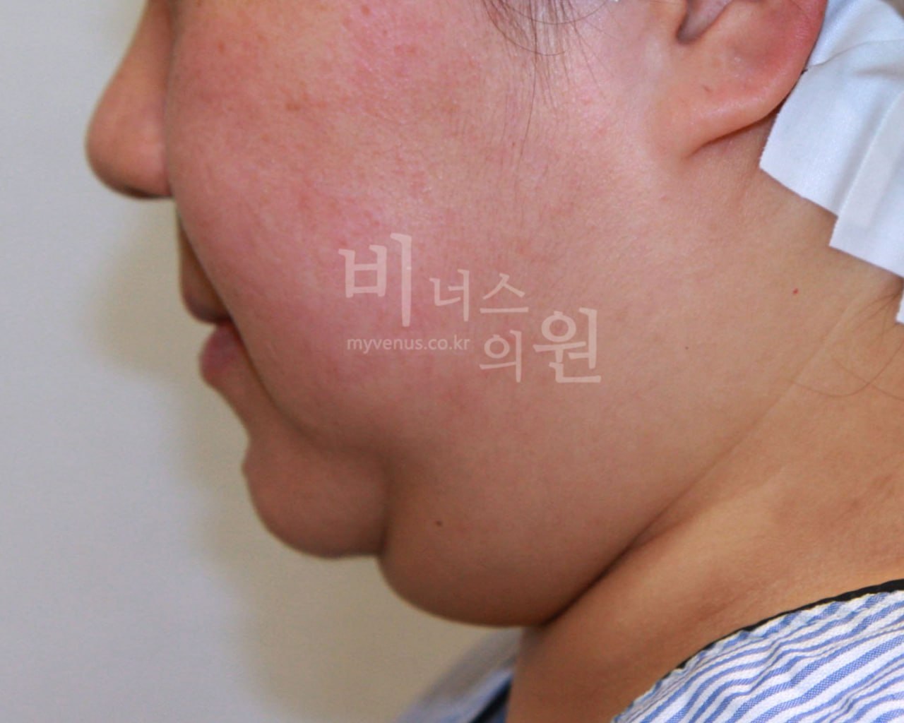 이중턱 얼굴 지방흡입 수술 전 우측면 비너스의원