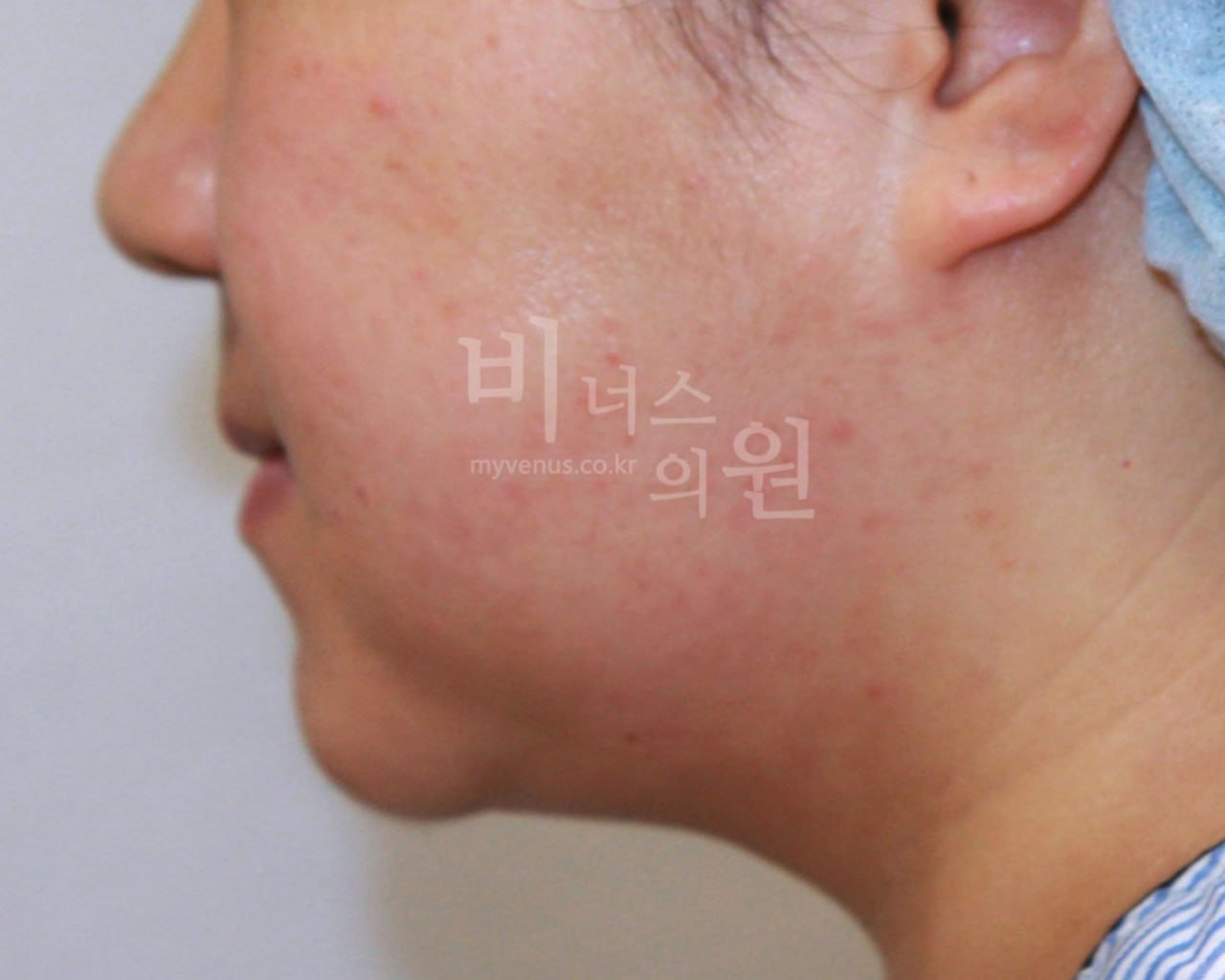 이중턱 얼굴 지방흡입 수술 후 우측면 비너스의원