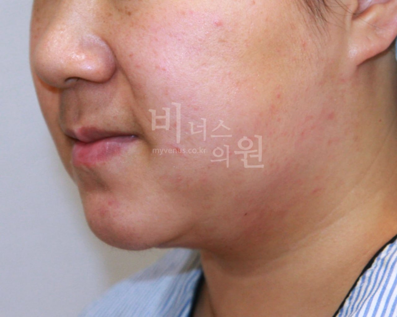 이중턱 얼굴 지방흡입 수술 후 우측 45도 비너스의원