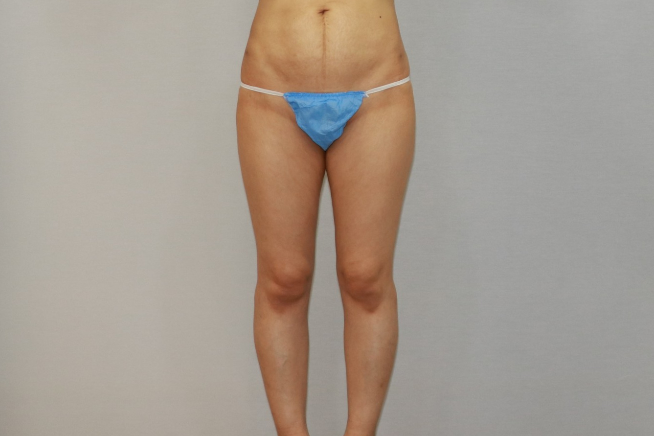 허벅지 원통형 안쪽 승마살 무릎 엉덩이 지방흡입 지방주입 수술전 .jpg