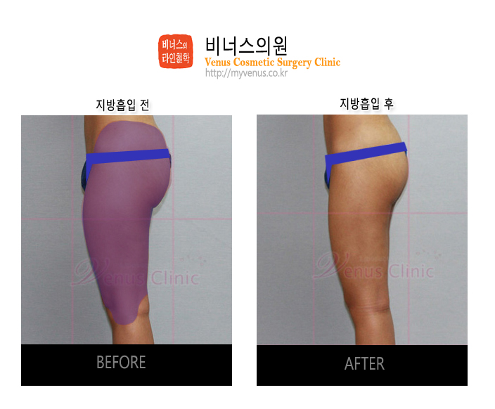 허벅지지방흡입3.jpg