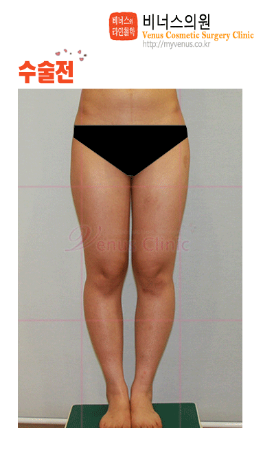 허벅지지방흡입.gif