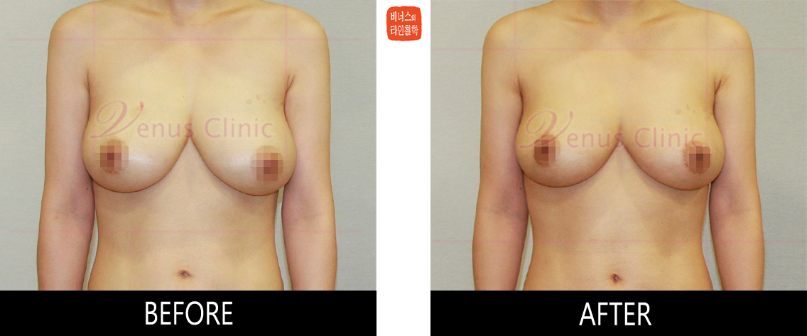 breast_liposuction-1.jpg