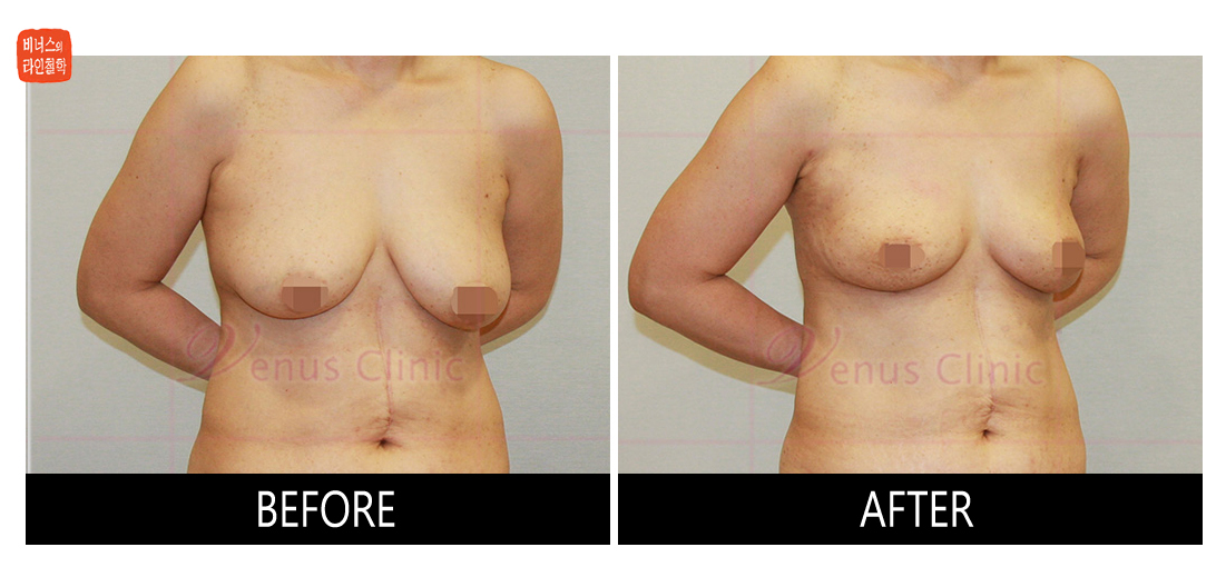 가슴축소 지방흡입 전후사진3