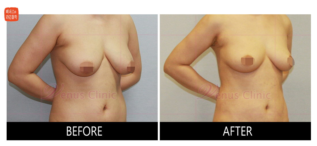 가슴축소 지방흡입 전후사진1