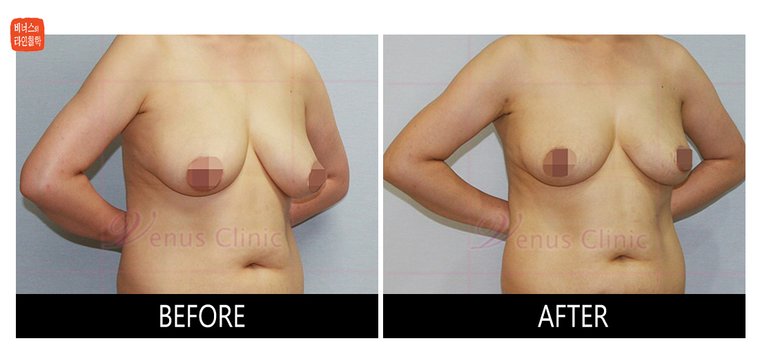 가슴축소 지방흡입 전후사진2