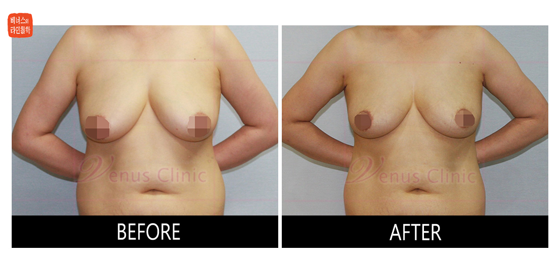 가슴축소 지방흡입 전후사진2