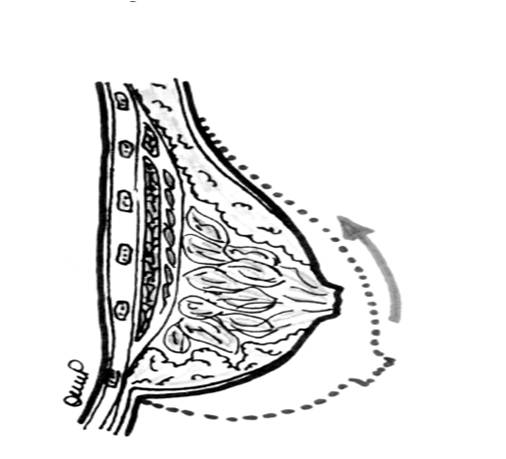 가슴축소 지방흡입