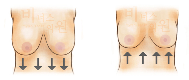 가슴축소 지방흡입-2.jpg