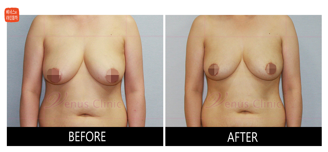 가슴축소 지방흡입 전후사진2