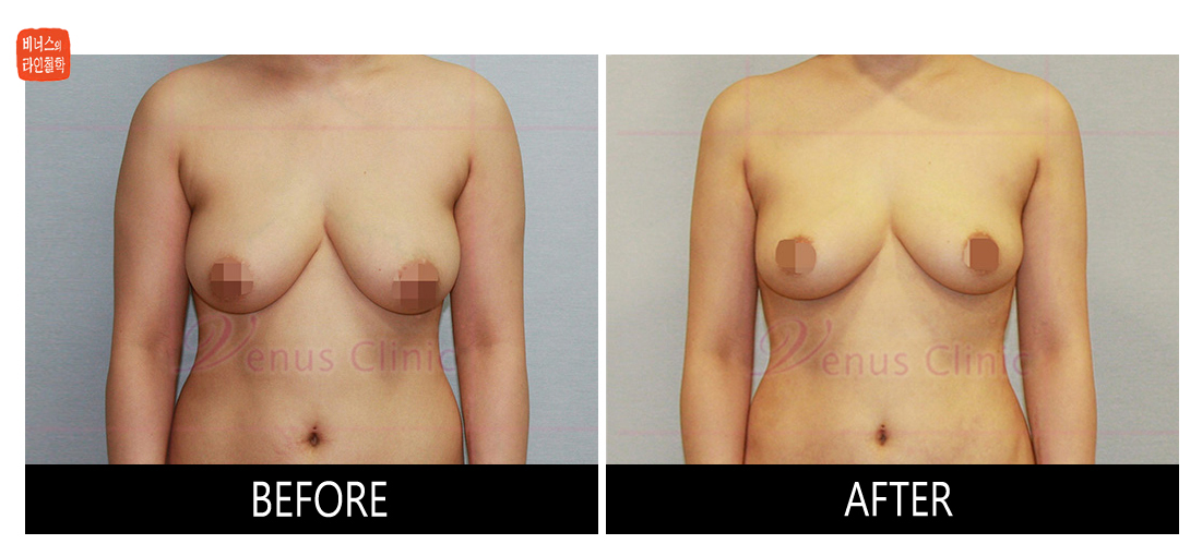 가슴축소 지방흡입 전후사진1