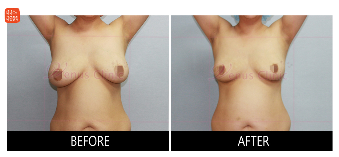 가슴축소 지방흡입 전후사진5