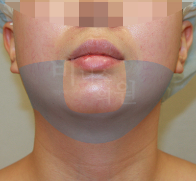 얼굴과 턱 지방흡입 전후사진2