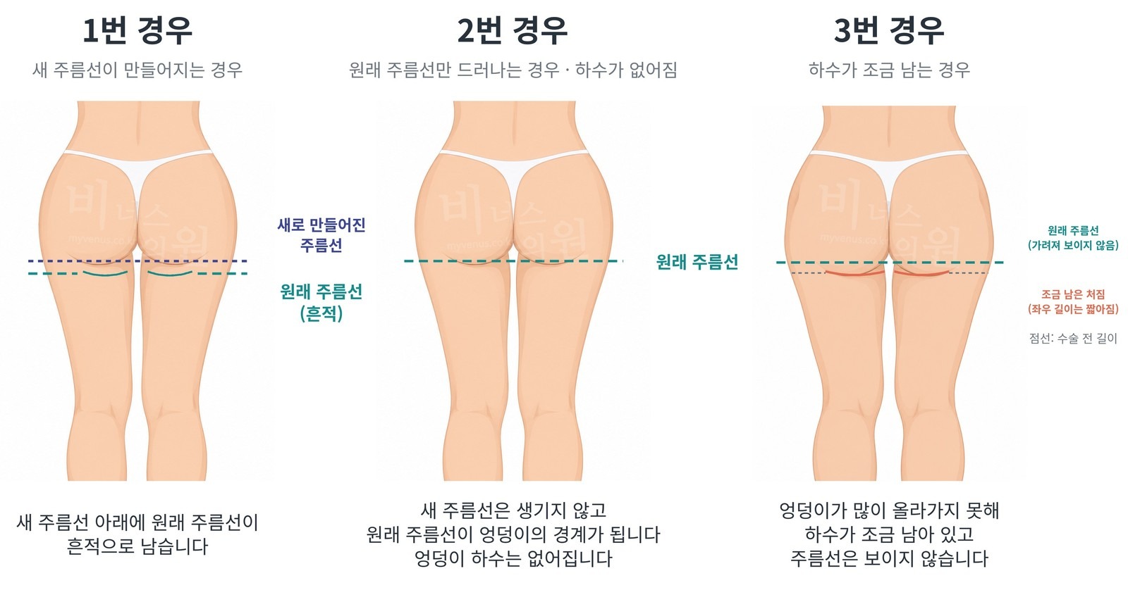 엉덩이 볼륨업 지방흡입 후 주름선의 세 가지 모습 — 1번 새 주름선이 만들어지는 경우, 2번 원래 주름선만 드러나는 경우, 3번 하수가 조금 남는 경우
