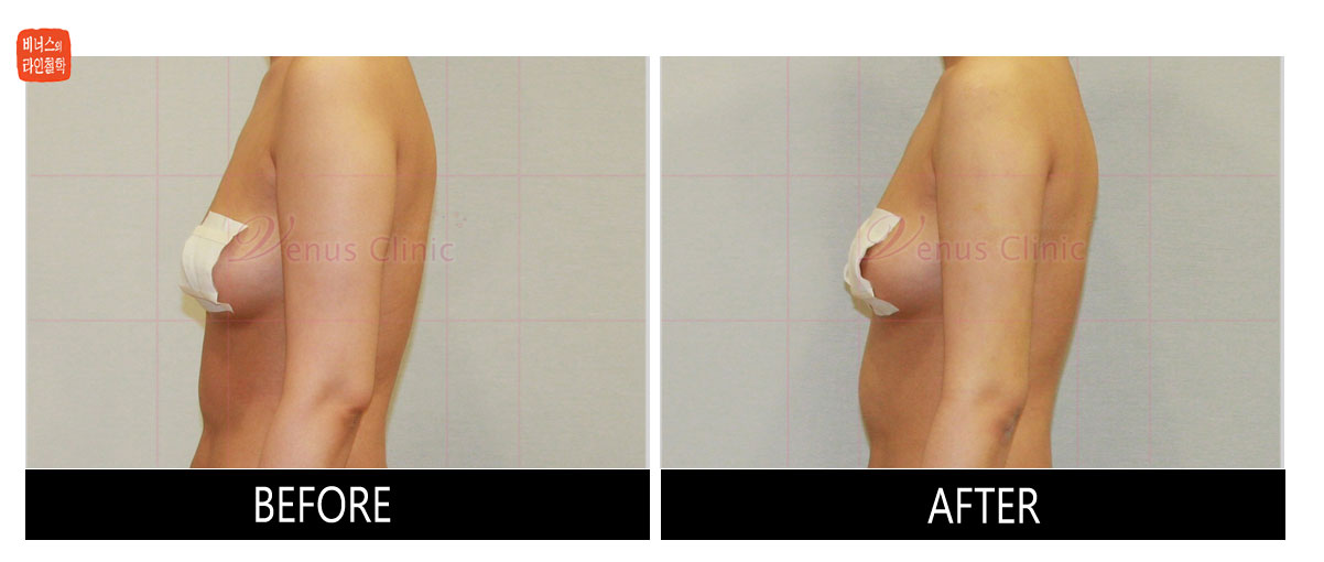 전후사진_arm3.jpg