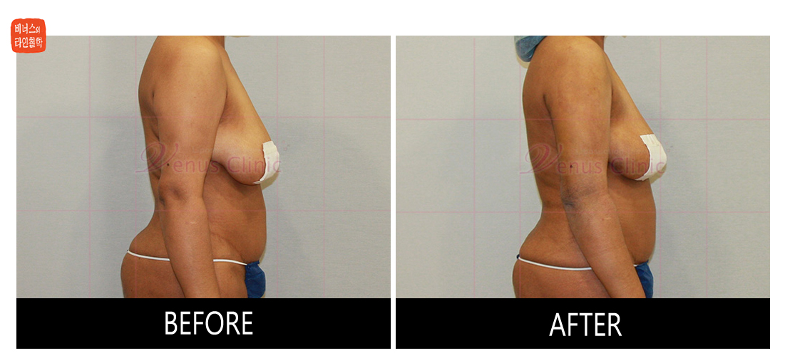 팔지방흡입재수술1.jpg