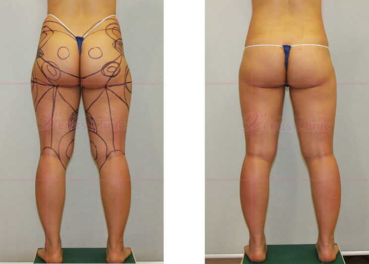 의학적 목적의 엉덩이 노풀사진1