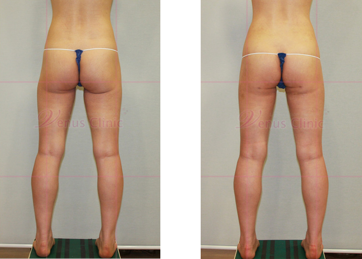 의학적 목적의 엉덩이 노풀사진2