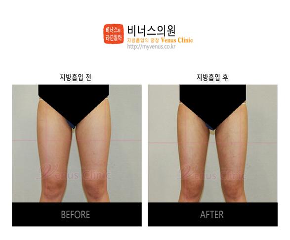 수술받지 않는 부위를 포토샵으로 감춘사진