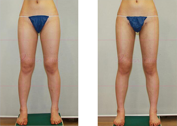 수술받지 않는 부위를 노출한 전후사진2