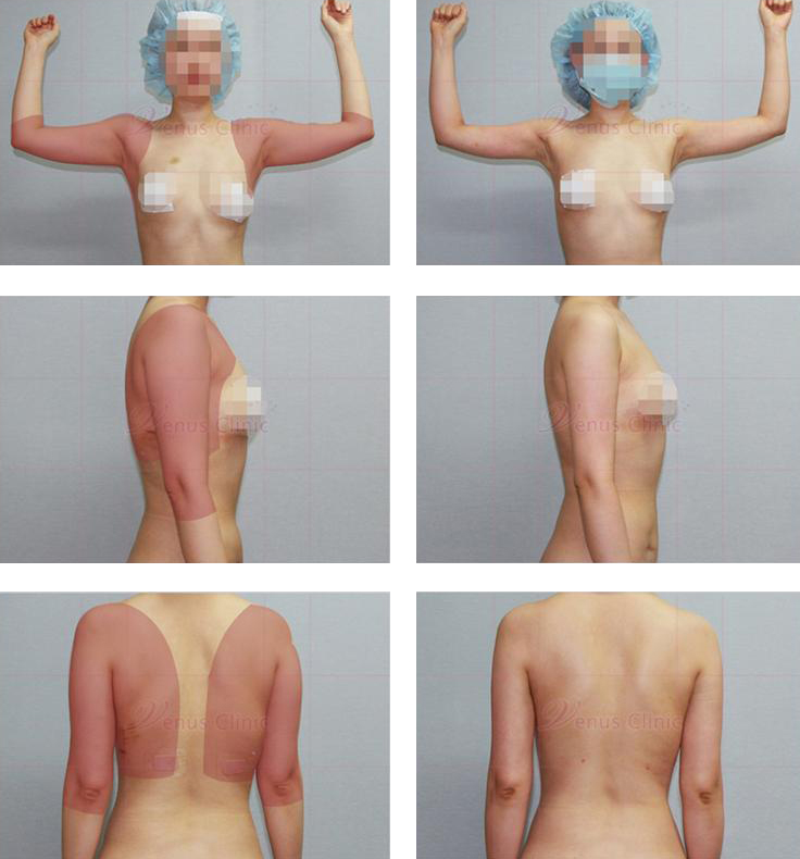 수술받지 않는 부위를 노출한 전후사진1