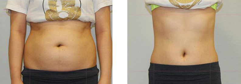 전측 복부 모자이크 안함