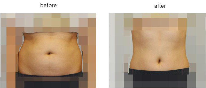 전측 복부 모자이크