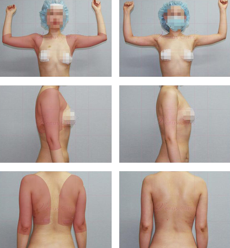 같은 자세에서 촬영한 지방흡입 전후사진