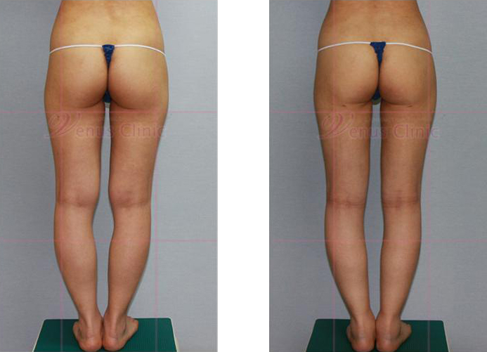 허벅지와 엉덩이 지방흡입 전후사진5