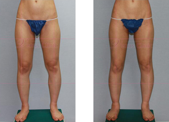 허벅지와 엉덩이 지방흡입 전후사진2