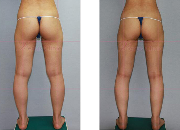 허벅지와 엉덩이 지방흡입 전후사진4