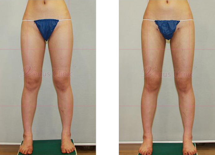 허벅지와 엉덩이 지방흡입 전후사진1