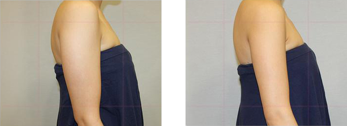 의학적 전후사진 비교2