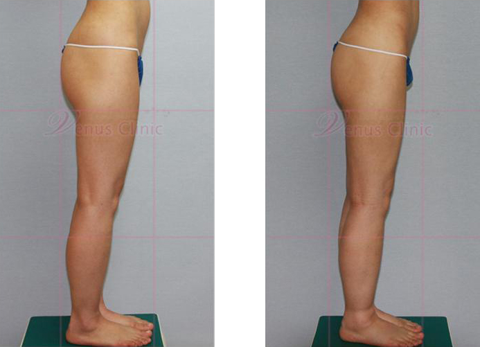 허벅지와 엉덩이 지방흡입 전후사진3