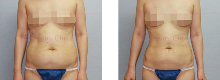복부 지방흡입 전후사진