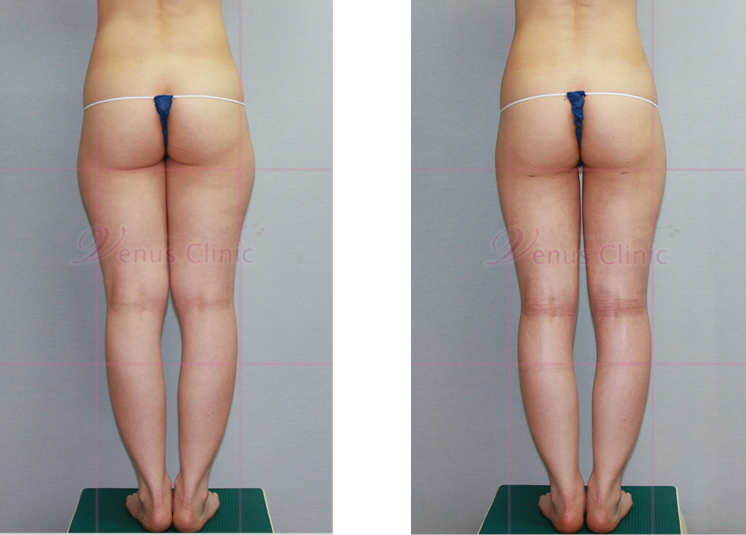 허벅지 지방흡입 전후사진4